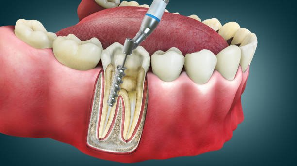 Root Canal Image