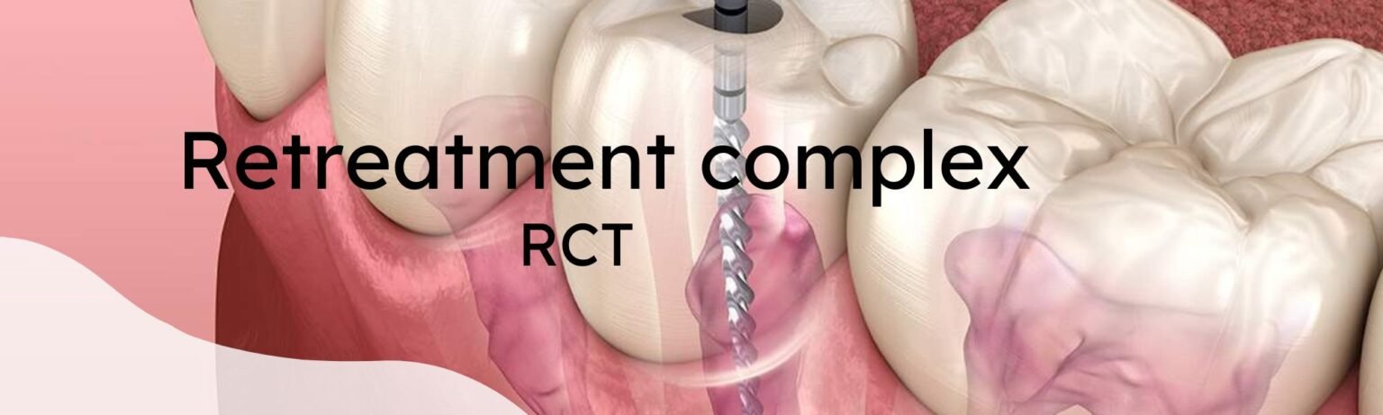Retreatment/ complex RCT – Cosmodent