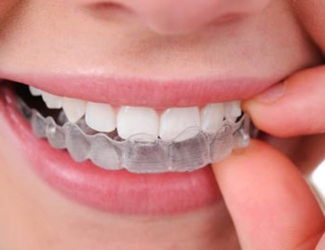 Aligner-Invisalign