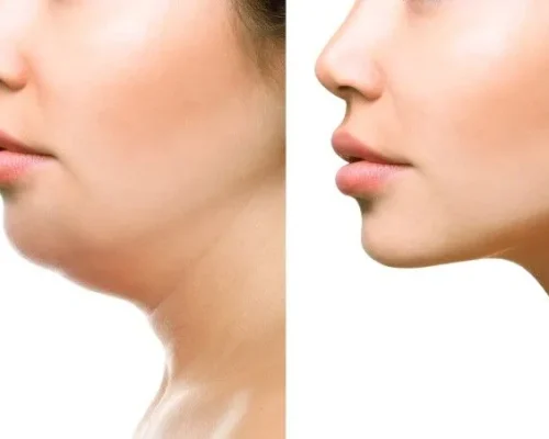 DOUBLE CHIN CORRECTION