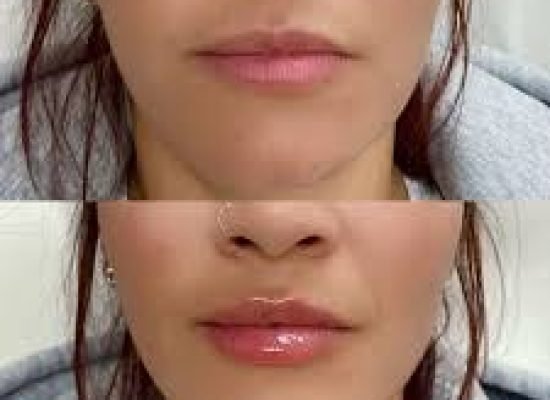 LIP PLUMP LIP FILLER