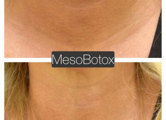 MesoBox