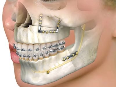 Oral-and-maxillofacial