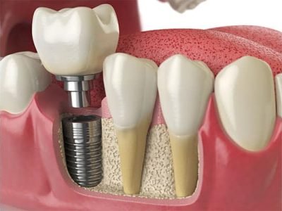 Prosthodontics