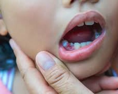 PulpectomyRCT for Kids