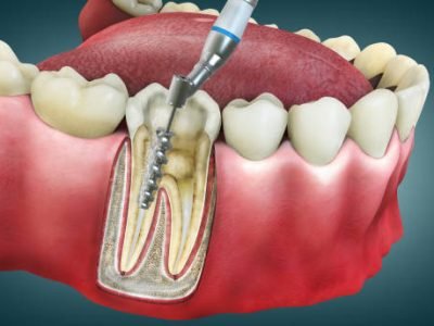 Root Canal Image