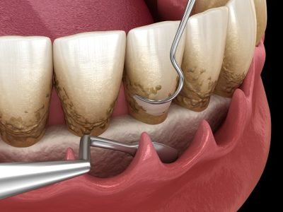 Open,Curettage:,Scaling,And,Root,Planing,(conventional,Periodontal,Therapy).,Medically